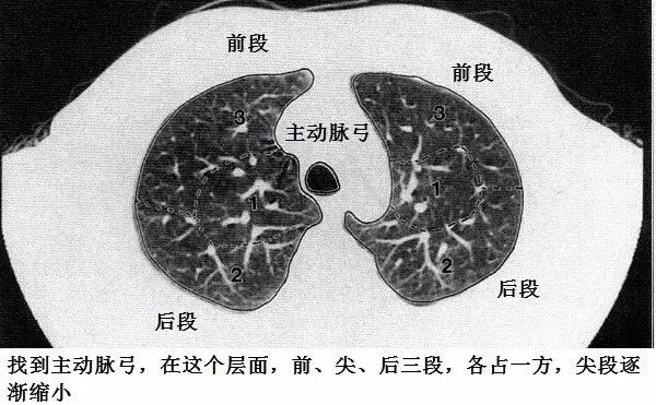 肺叶分段ct示意图ppt图片