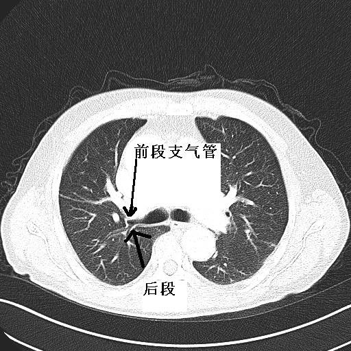 結果,超聲探頭進入前段,病灶出現了!