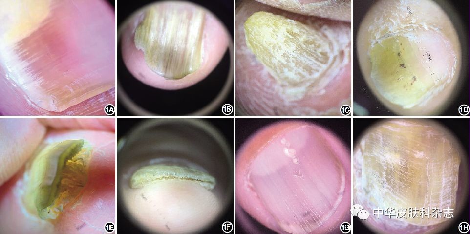 銀屑病甲與甲真菌病的皮膚鏡特徵分析_醫學界-助力醫生臨床決策和職業