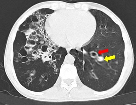 支气管囊肿影像图片
