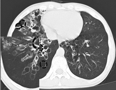 3.囊状支气管扩张