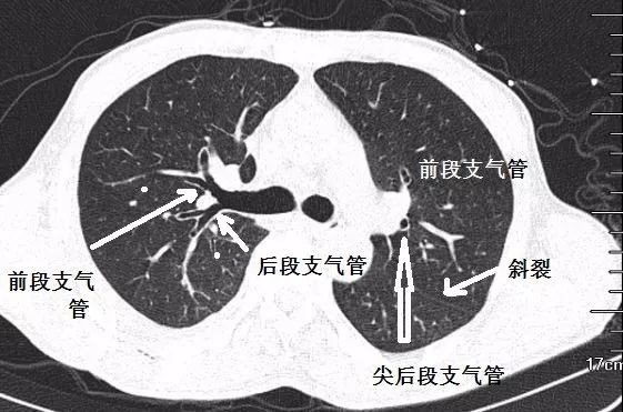 这才是支气管ct解剖最佳学习资料!