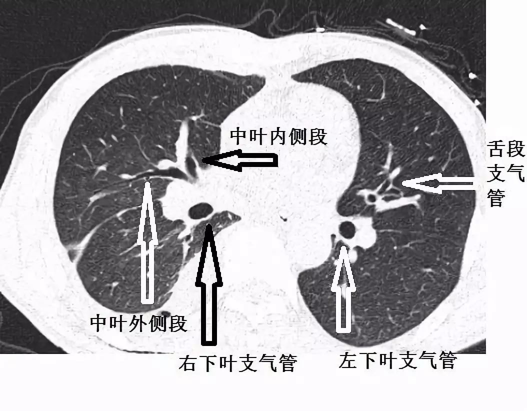 这才是支气管ct解剖最佳学习资料!