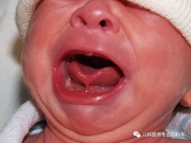 宝宝舌系带过短一定要切吗？