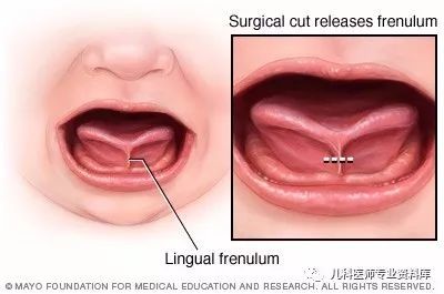 宝宝舌系带过短一定要切吗？