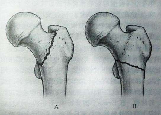 右股骨粗隆间骨折图片图片