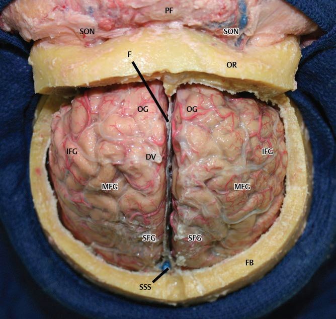 =大腦鐮; fb =額骨; ifg =額下回; mfg =額中回;og =眶回; or =眶上緣