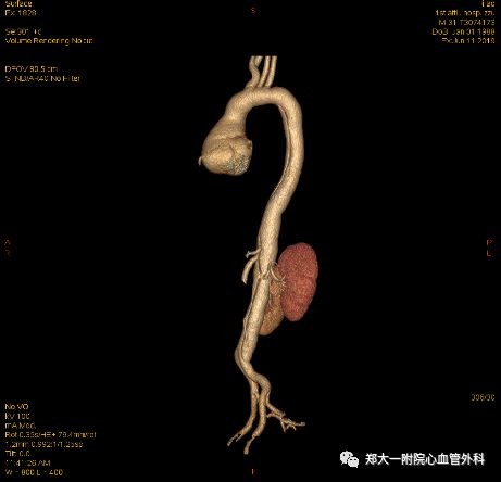 马凡氏综合征——是上天的馈赠?还是隐形的"杀手"?