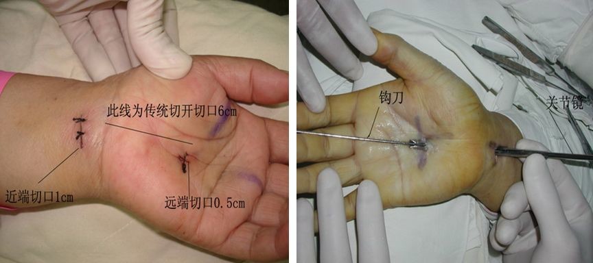 一招学会 | 快速掌握"腕管综合征"