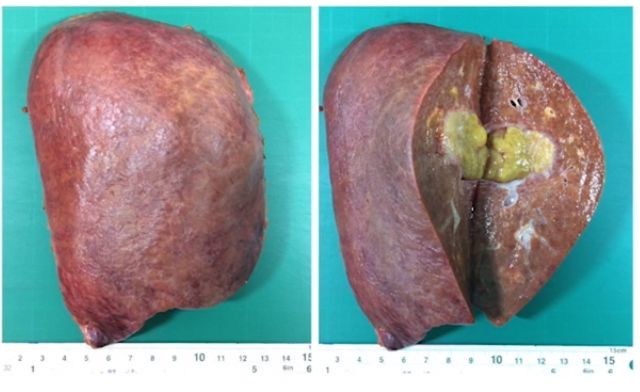 术式详解 | glissonian入路腹腔镜中肝(s4 5 8)切除术_医学界-助力