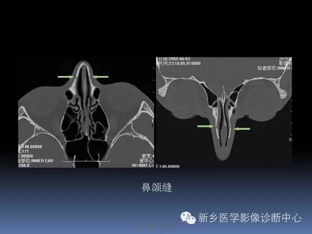 写鼻骨骨折CT报告,一定要了解的解剖_医学界-助力医生临床决策和职业成长