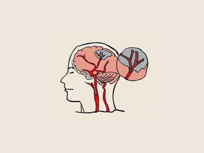 STROKE：Nelonemdaz II期试验结果如何？_医学界-助力医生临床决策和职业成长