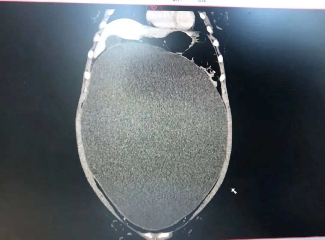 13岁女生肚子隆起爬满「妊娠纹」,照完ct妈妈当场吓懵!