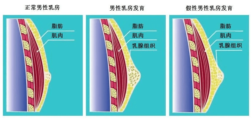 67青春期男孩乳房发育直径长达4cm,性早熟还是另有原因?