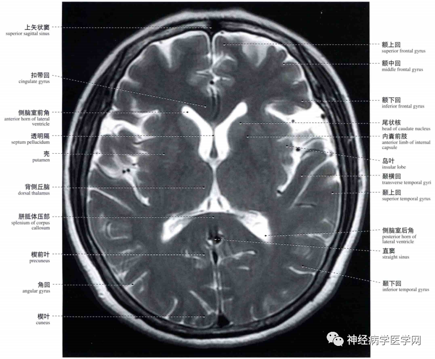 脑干横断面图片