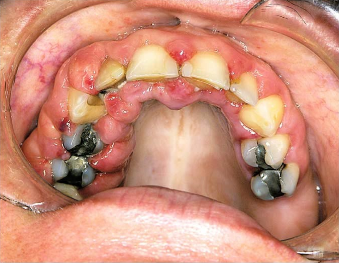 白血病的牙龈病损图片