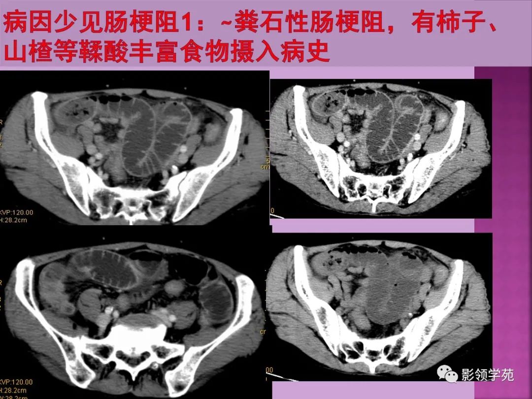 消化影像图解:小肠梗阻的ct诊断