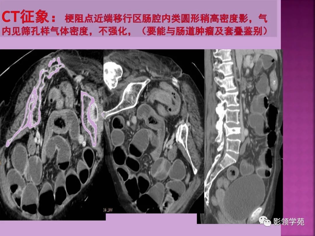 正常肠道图片ct图片