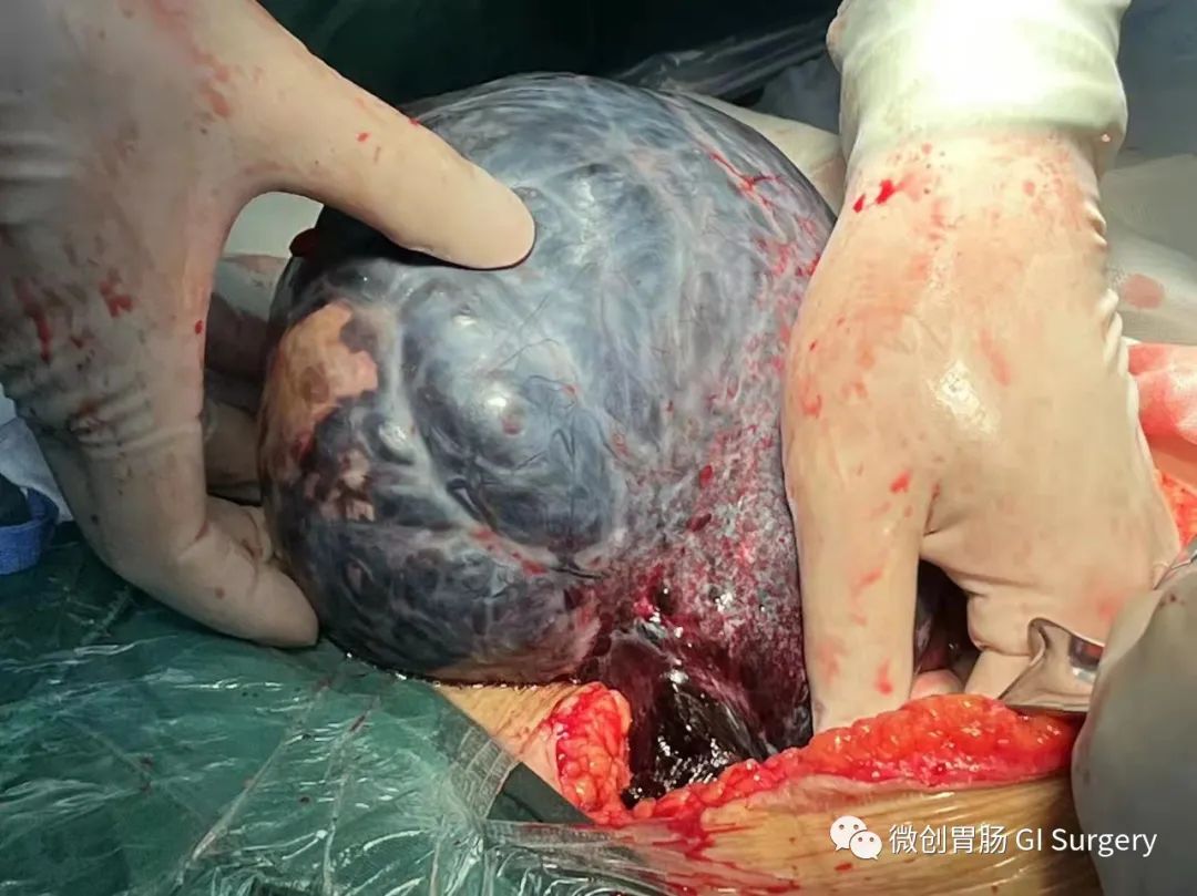 急腹症系列——卵巢巨大粘液性囊腺瘤蒂扭转一例