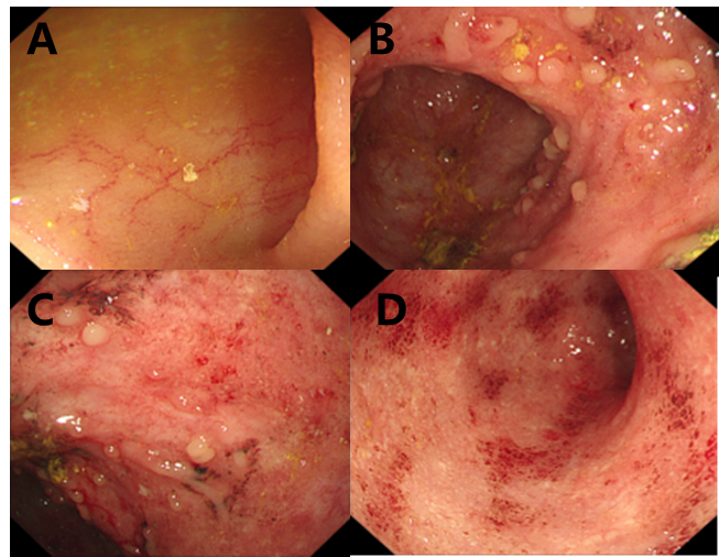 间断腹泻患者下肢突然烂了