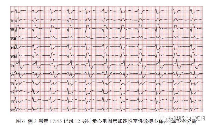 特殊的同源心室分离心电图分析_医学界-助力医生临床决策和职业成长