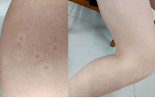 儿童发病者常有病毒感染的全身症状,如有全身乏力,发热,头痛,咽喉痛