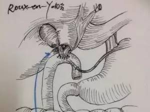 腹腔镜胆总管囊肿切除术_医学界-助力医生临床决策和职业成长