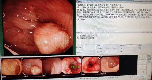 12个肠镜,就发现2例大肠癌,6例肠息肉——肠镜检查