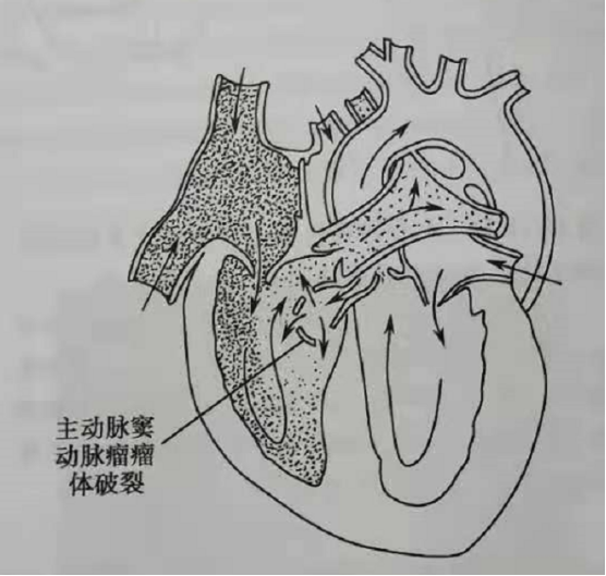 图17 主动脉窦瘤破裂示意图小科普主动脉窦瘤是在主动脉窦部包括右主