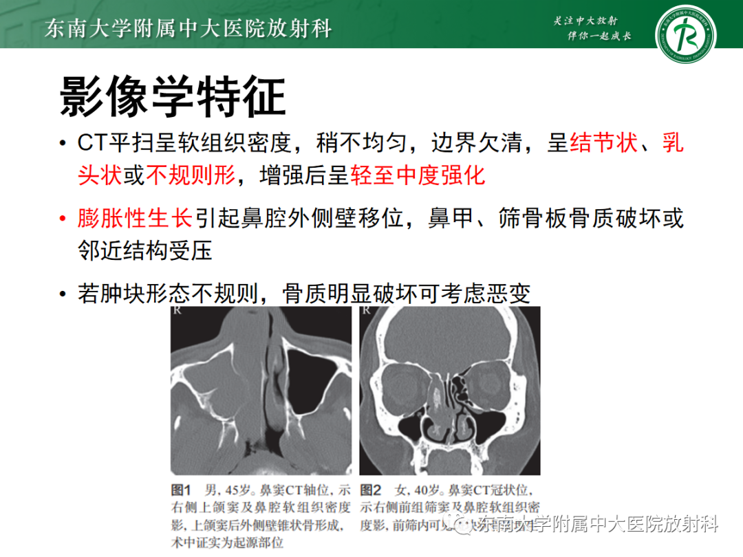 鼻内翻性乳头状瘤 影像表现