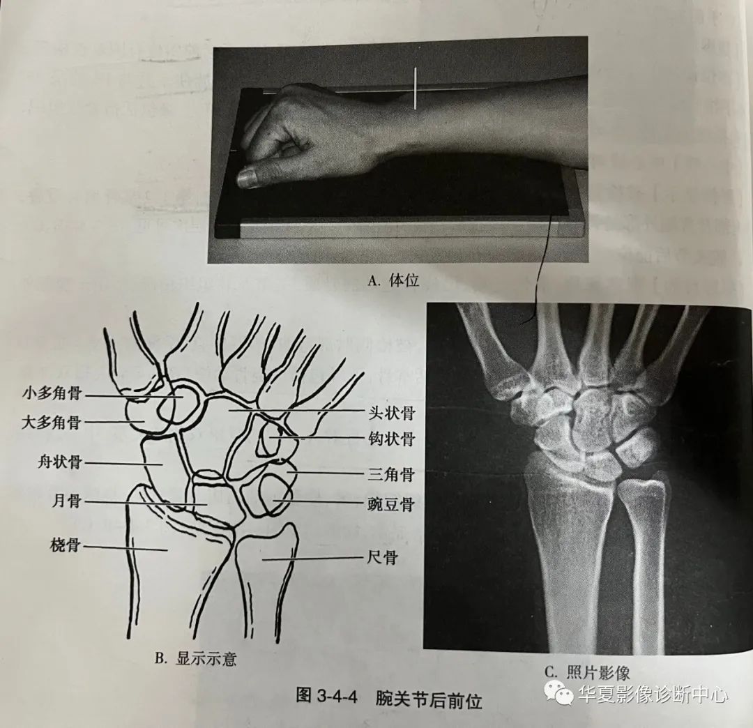 腕关节的读片技巧