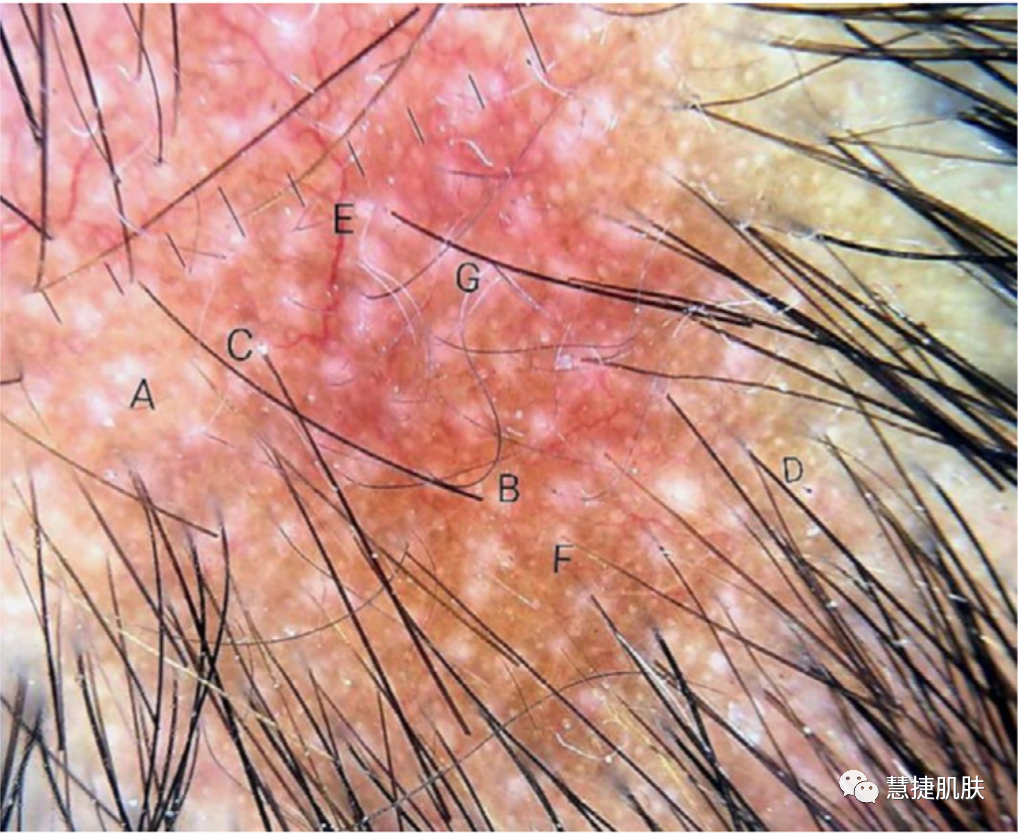 梅毒性脱发的皮肤镜表现