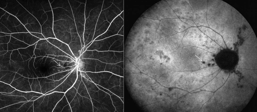 反复出现飞蚊症,生理盲点扩大,你会想到这种眼病吗?