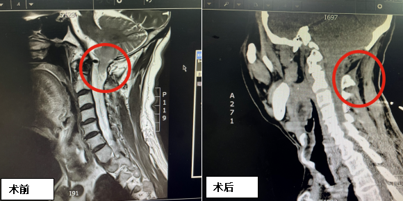 小腦扁桃體下疝術後,患者兩度窒息,原因何在?如何預防?