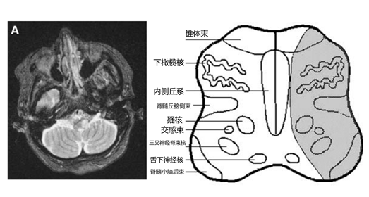 看完這一篇短文,延髓綜合徵真的是記住了_醫學界-助力醫生臨床決策和