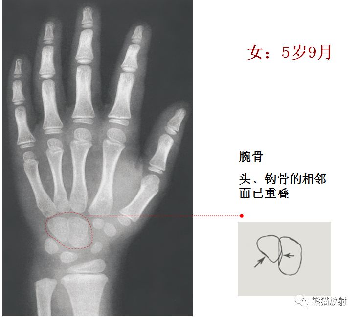 骨龄片子怎么看左手图片