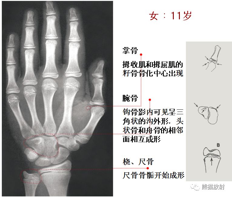 女孩骨龄对照图 图谱图片