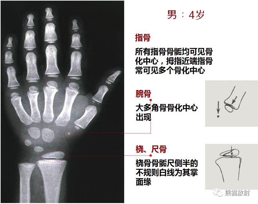 务必收藏丨最全骨龄图谱!(方便随时对照)