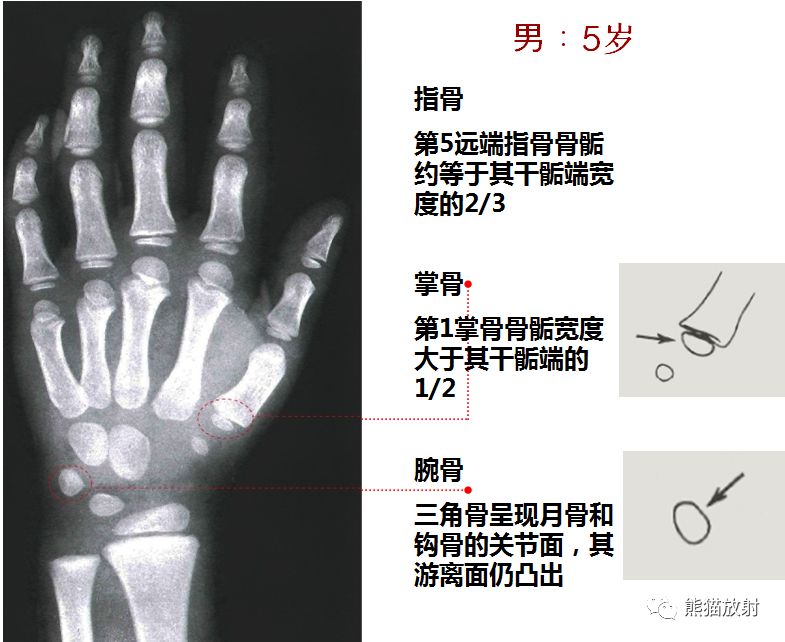 男孩骨龄图谱女孩骨龄图谱上图中的数字为相应骨出现时的年龄骨龄评估