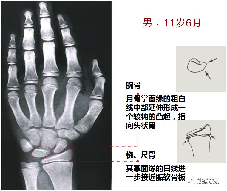 男孩骨龄图谱 男童图片