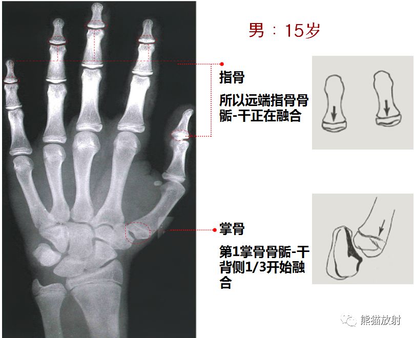务必收藏丨最全骨龄图谱!(方便随时对照)