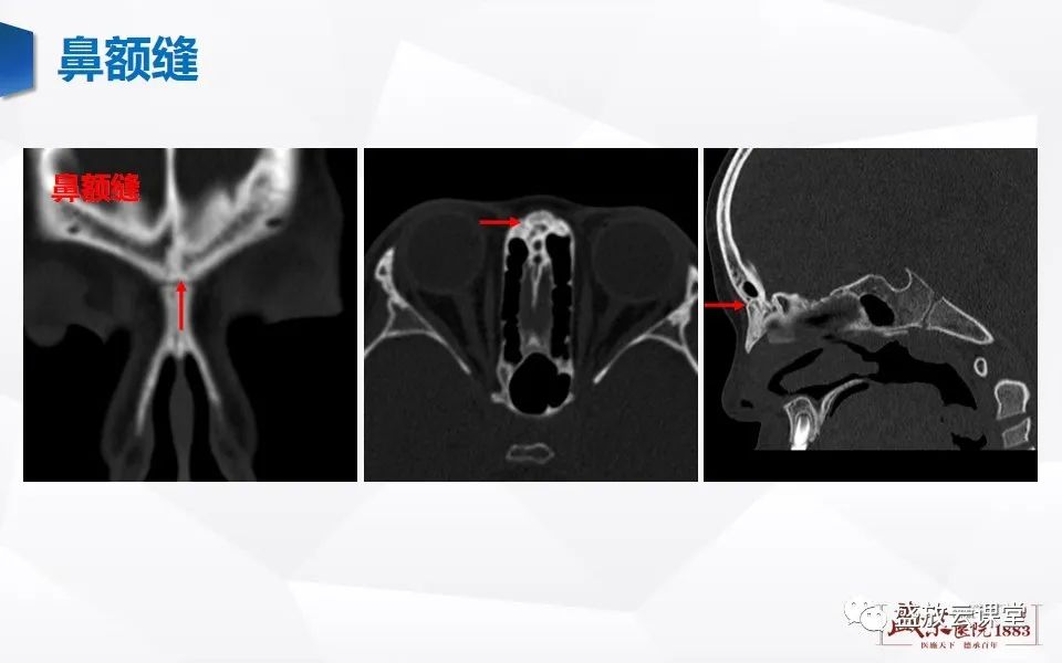 鼻骨正常ct解剖變異與骨折