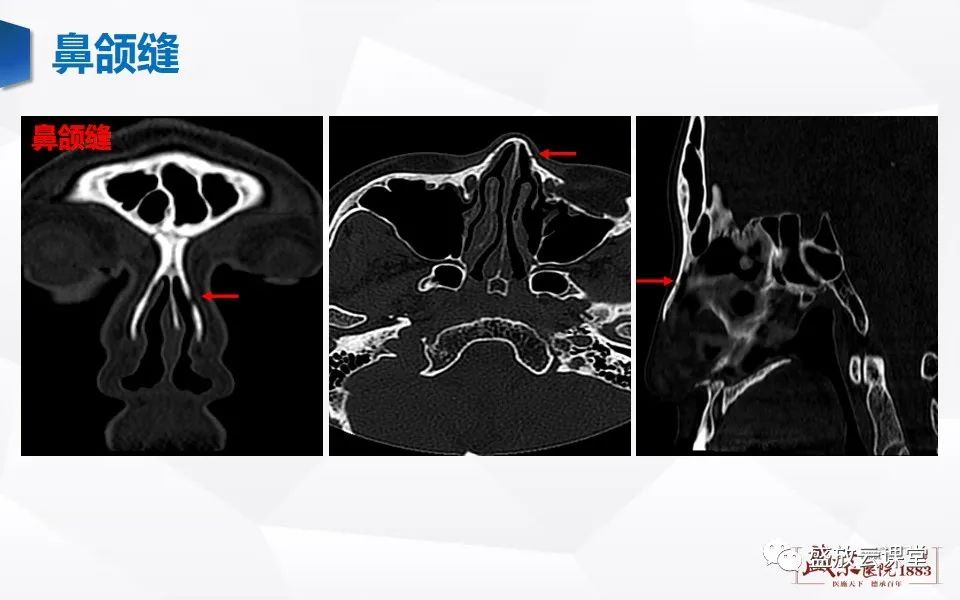 鼻骨正常ct解剖
