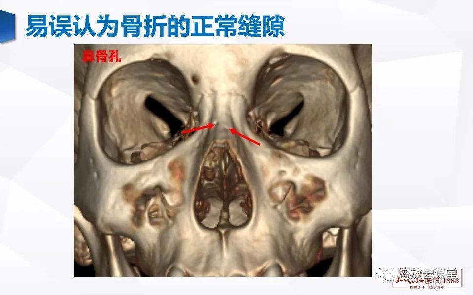 鼻骨解剖图ct图片