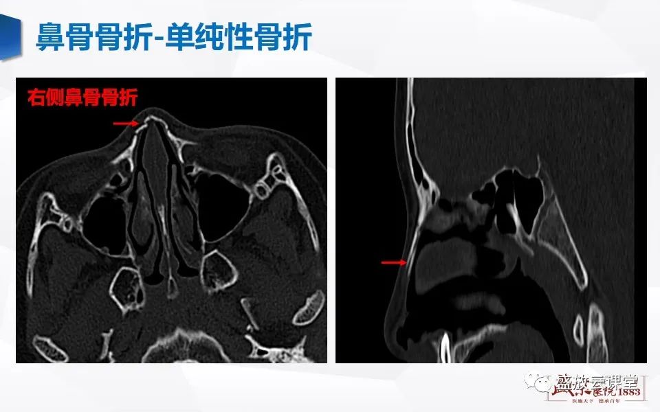 鼻骨正常ct解剖變異與骨折