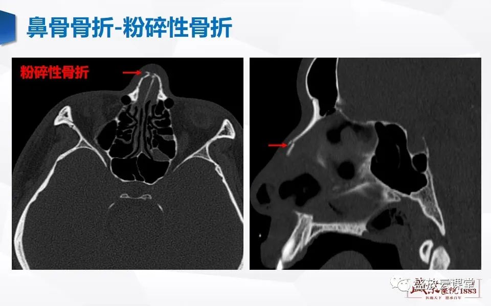 鼻骨正常ct解剖 变异与骨折 医学界 助力医生临床决策和职业成长