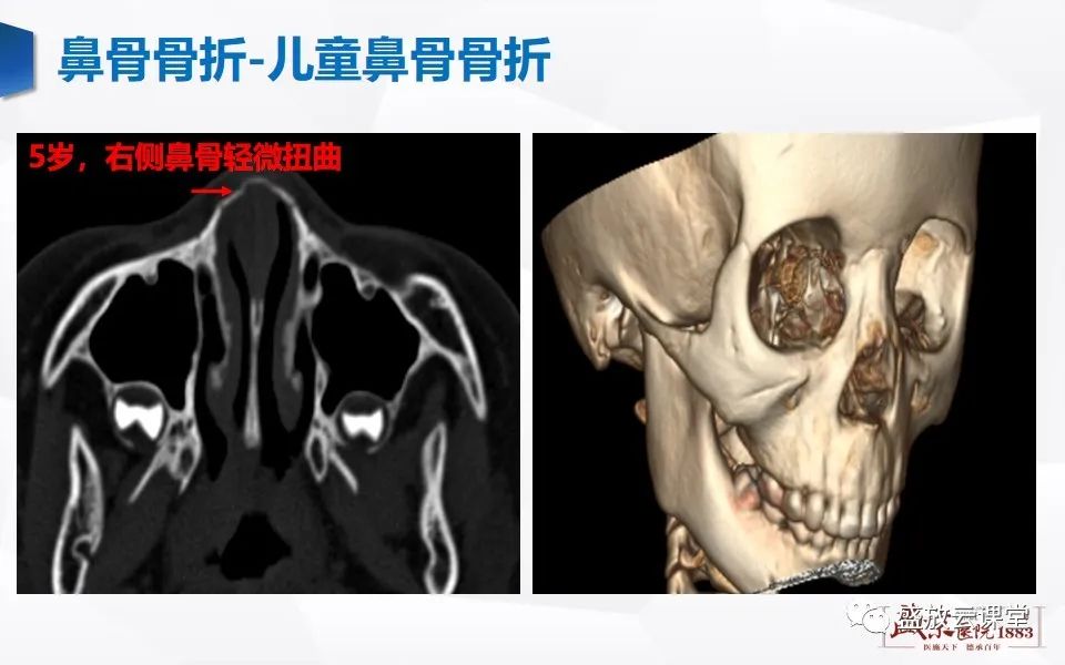 正常人鼻子ct图片图片