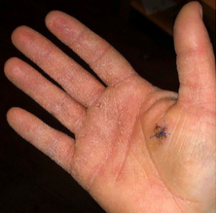 接触水后手掌及手指掌面出现密集的灰白色水肿性角化丘疹及斑块(图1,2