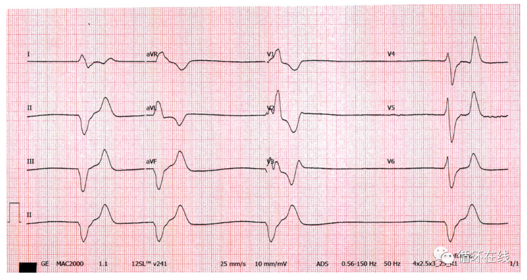 低血钾心电图图形图片