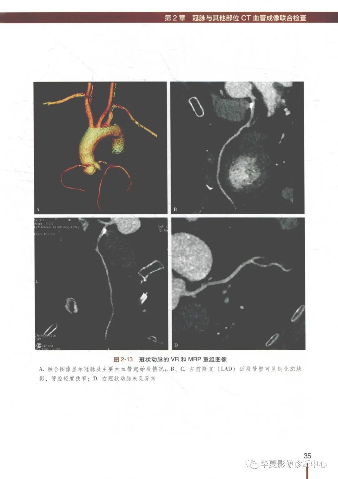 冠状动脉CT血管成像最新临床应用推荐及诊断规范